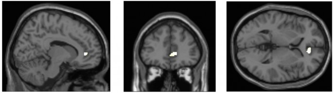 기능성자기공명영상(fMRI)로 확인한 결과, 미디어 멀티테스킹을 많이 할 수록 뇌의 회백질(흰색 점)의 밀도가 낮아지는 것으로 나타났다. - Plos One 제공